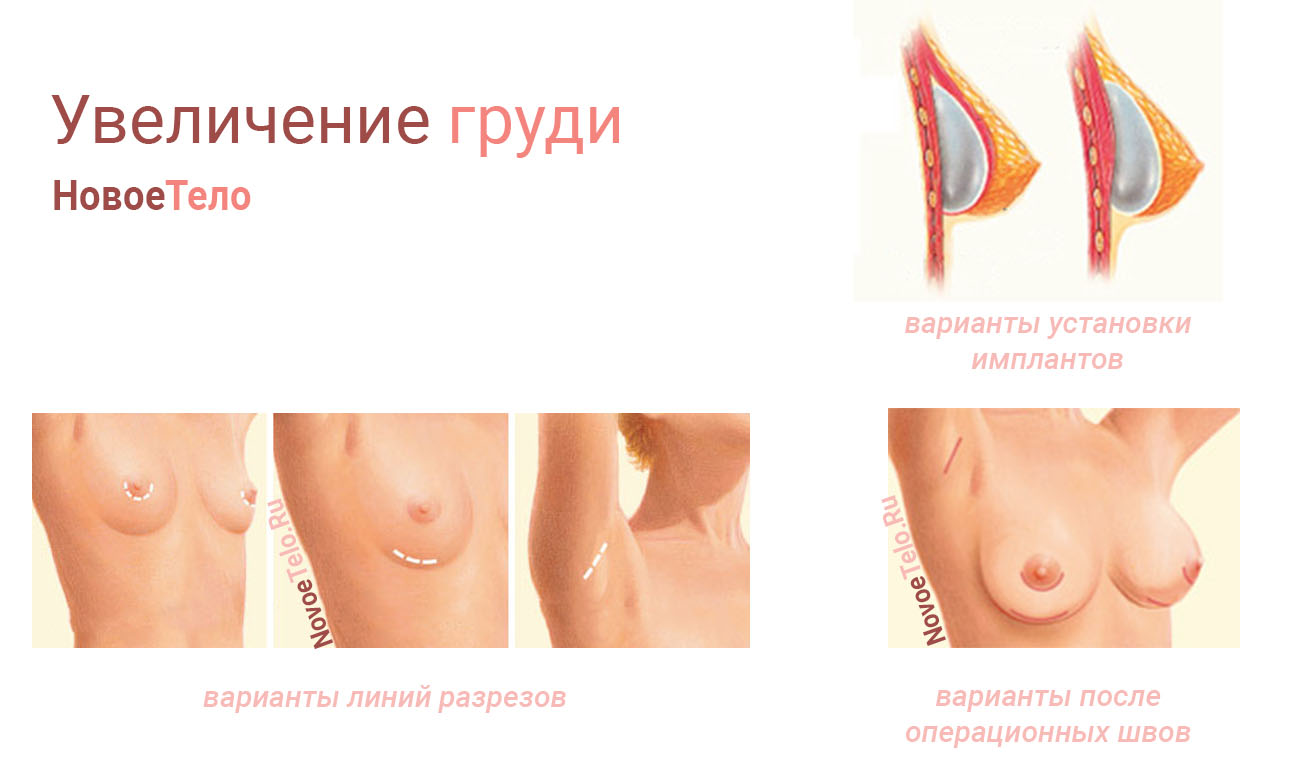 Увеличение груди (аугментационная маммопластика)